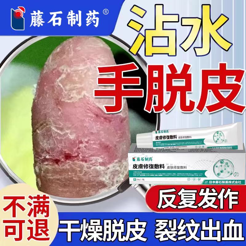沾碰水手脱皮膏指缝溃烂烂手丫修止痒小水泡瘙痒专用药房同售SK