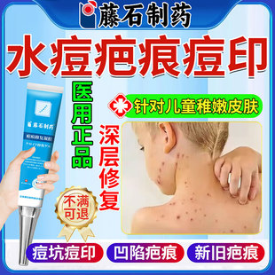 儿童水痘疤痕修复凝胶去水痘坑痘印生长凹陷因子去祛疤膏黑沉淀SK