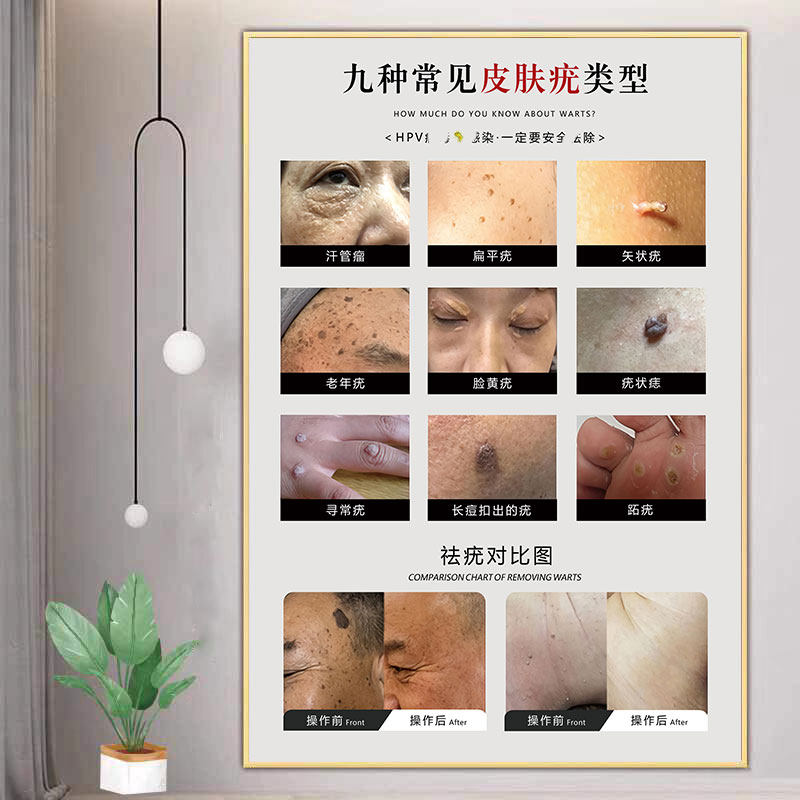 祛疣广告扁平疣图片皮肤赘生物挂画祛斑猴点痣宣传图祛痣祛疣海报
