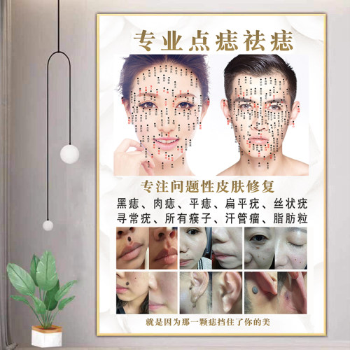 祛痣广告图点痣宣传图kt板男女