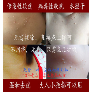 传染性软疣儿童大人宝宝软疣水猴子软尤水瘊子非膏刮勺镊子