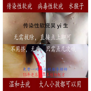 儿童传染性软疣儿童大人宝宝软疣水猴子软尤水瘊子非刮勺镊子