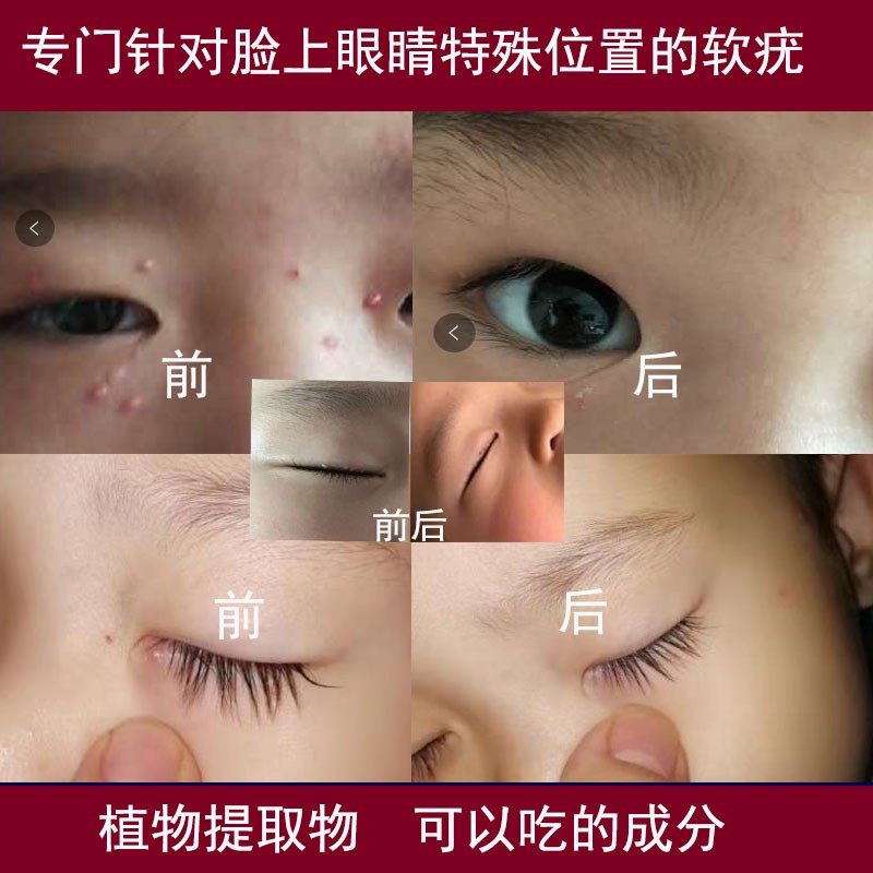 皮炎湿疹干裂脱皮瘙痒荨麻疹玫瑰糠 确诊后下单