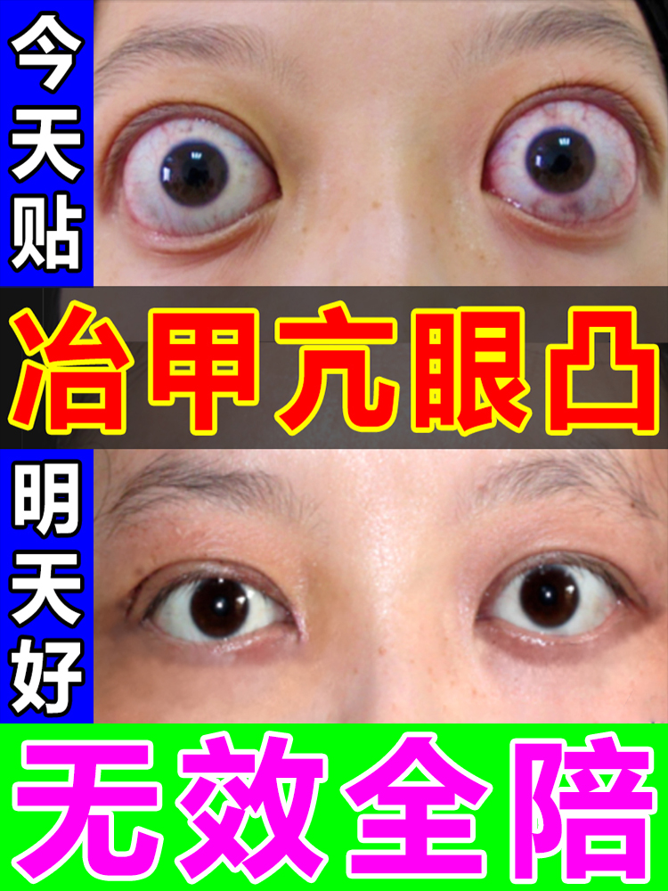甲亢眼突眼贴甲减消桥本甲状腺眼凸水肿眼球突出疼痛肿胀矫正神器