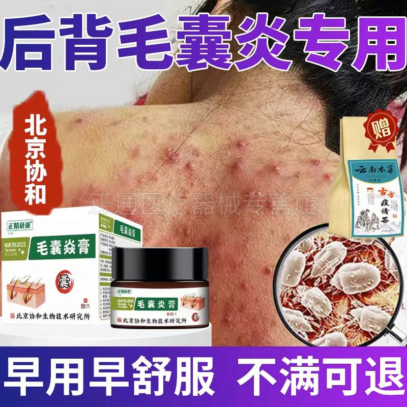 后背毛囊炎真菌感染抑i菌膏去痘印痘坑痘疤凹洞填充毛孔淡化