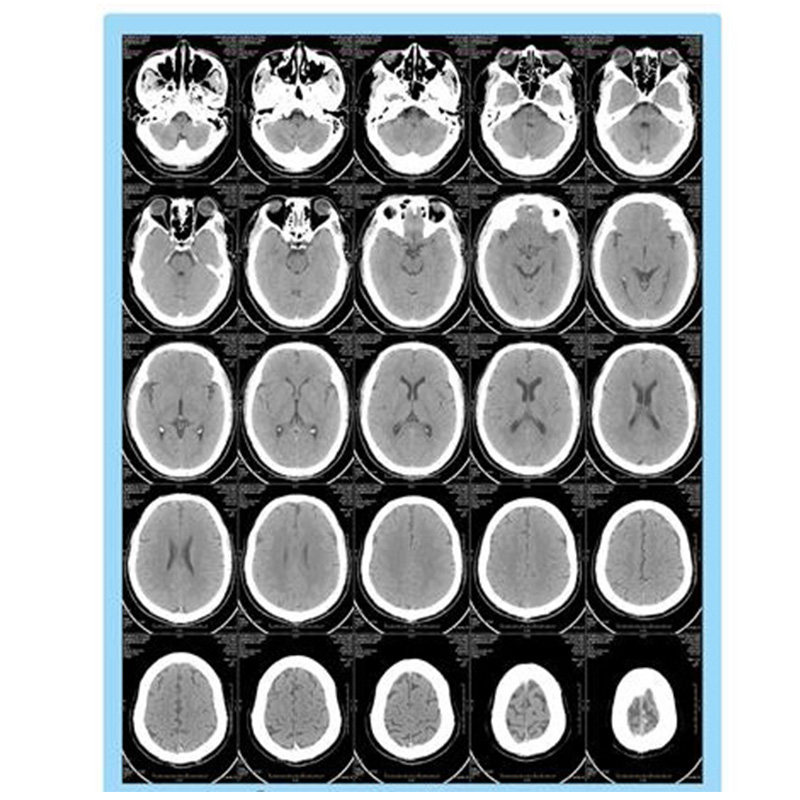 热敏胶片X光医用胶片热敏打印胶片DR热敏相机CT医用干式胶片8X10