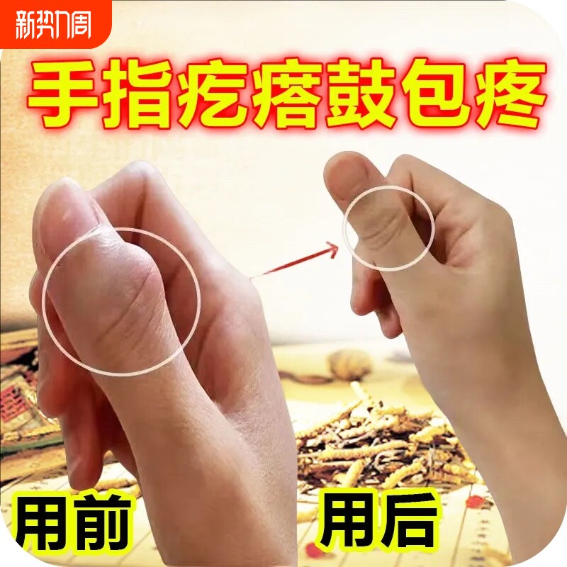 手指骨节粗大变形关节疙瘩鼓包肿大消肿疼痛专用活络