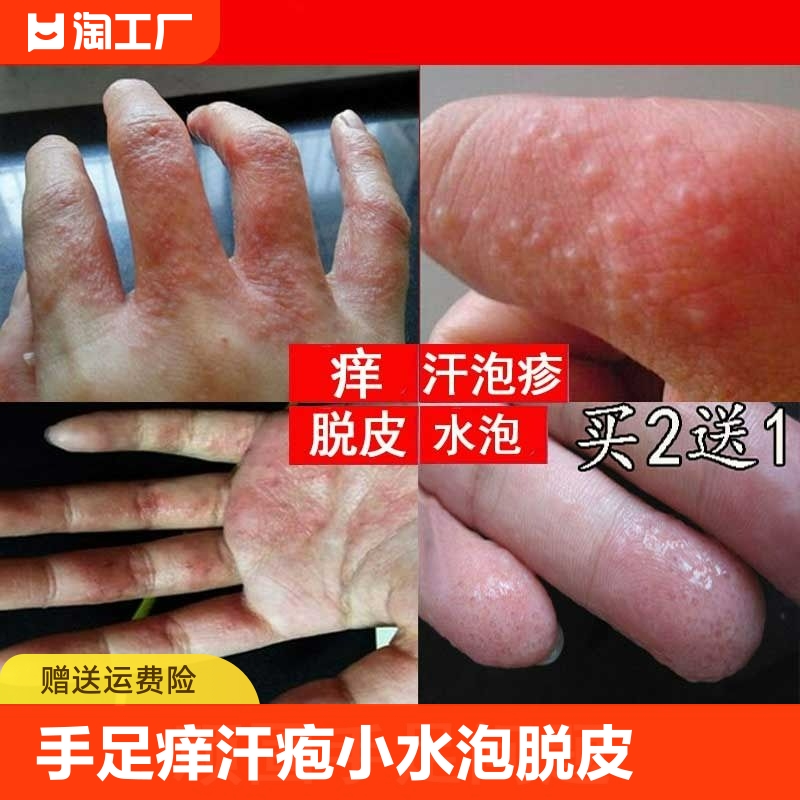 手上起小水泡手足脱皮汗泡疱珍疹药膏开裂止痒手痒烂水泡汗孢庖疹 保健用品 皮肤消毒护理（消） 原图主图