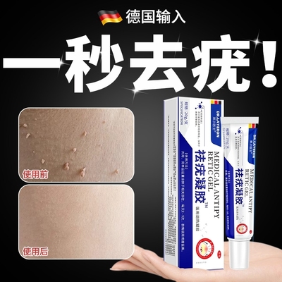 去疣瘊小肉粒一抹灵无忧去除扁平疣丝状疣瘊子软膏药官方旗舰店水