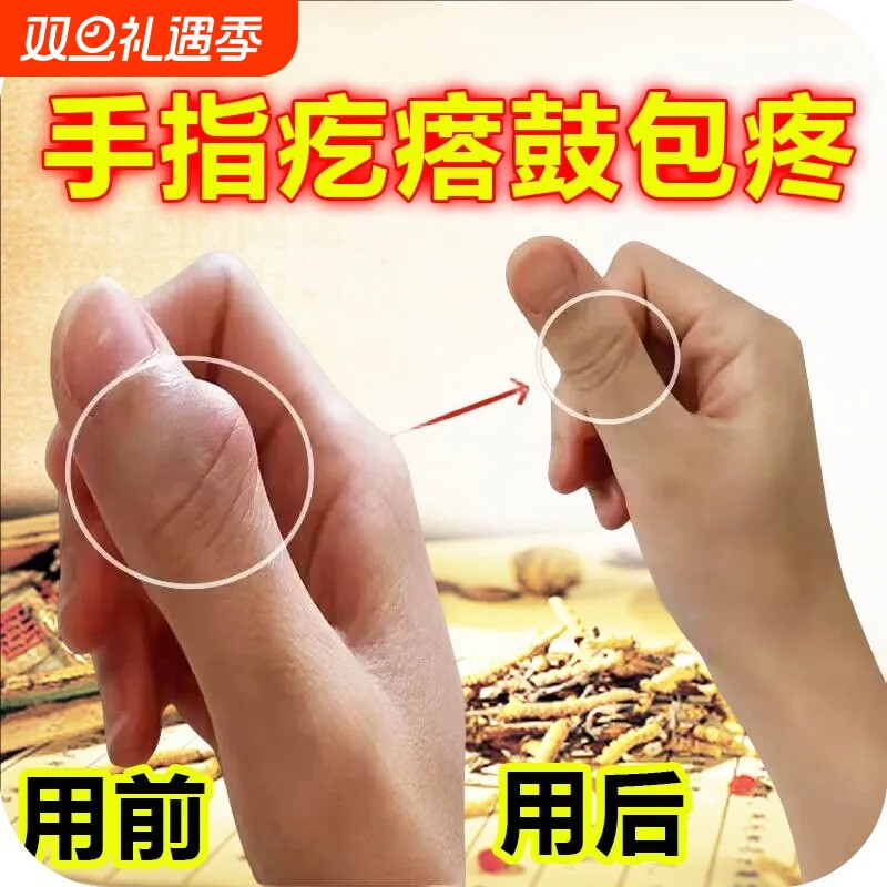 手指骨节粗大变形手指关节疙瘩鼓包手指肿大消肿手指疼痛专用