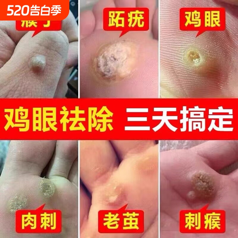 云南本草鸡眼贴鸡眼膏鸡贴眼正品去脚底鸡眼药膏去除液老茧草本