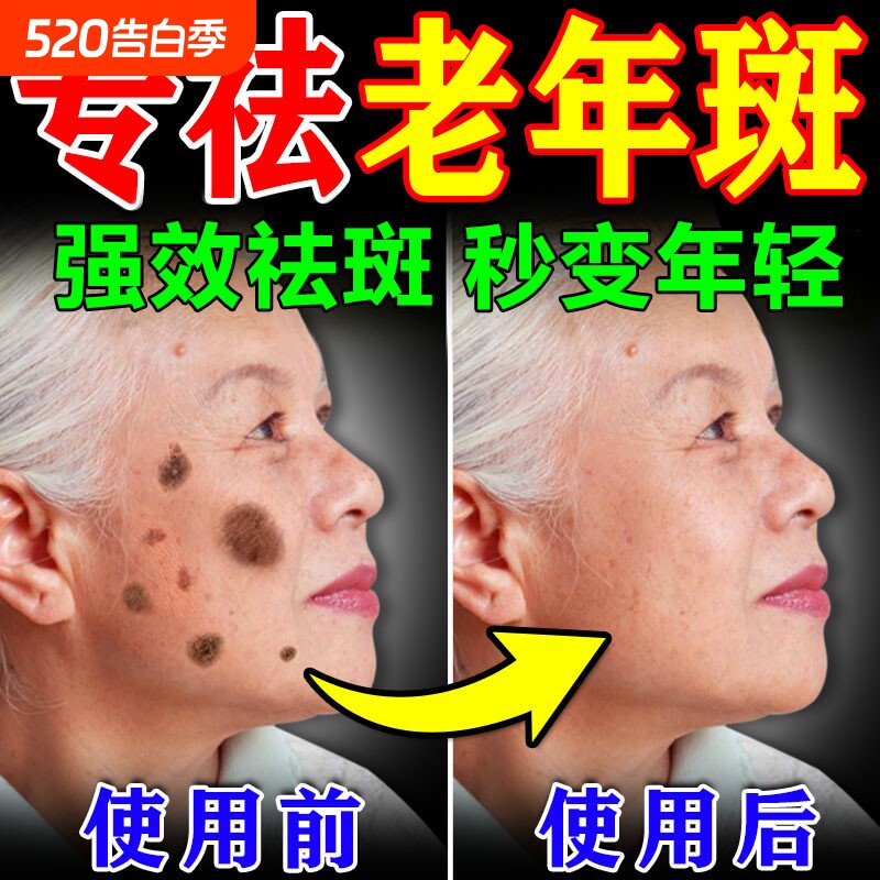 老年斑美白祛斑霜黄褐专用膏药强力去手部除脸部一擦就掉中老年人