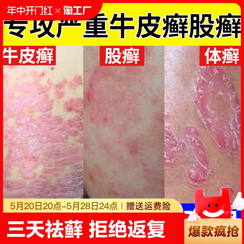 股藓大腿内侧根皮肤瘙痒真菌感染牛皮癣药体股癣去湿疹止痒膏顽固