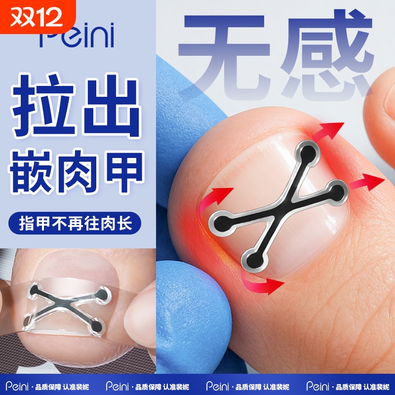 【无感矫正】拉出肉里的趾甲