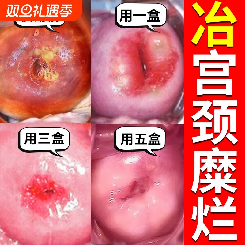 北京同仁堂宫颈糜烂重度专用中药消糜栓妇科凝胶治疗阴道炎白带多