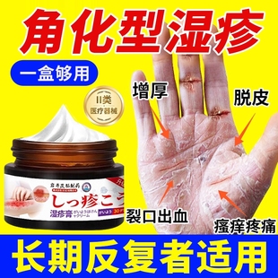 角化型濕疹手癬膏脫皮干裂真菌感染角質(zhì)化皸裂性濕疹手癬足癬藥膏