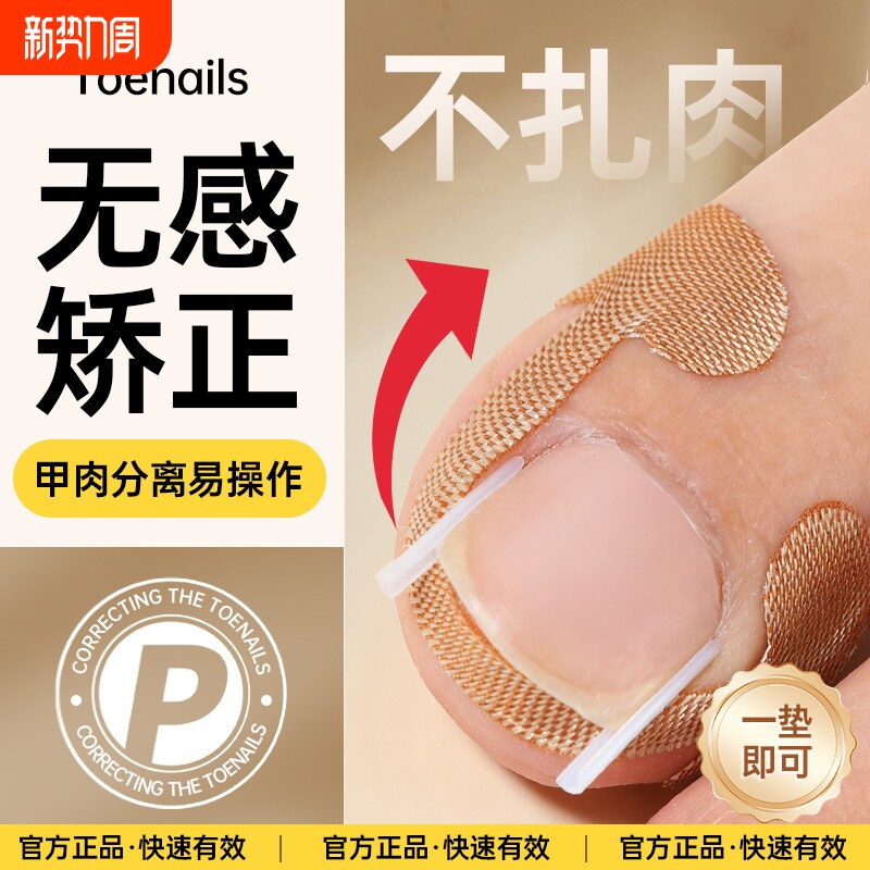 甲沟神器指甲矫正器嵌甲专用拉贴隔离脚趾甲长肉里填充垫片纠正炎