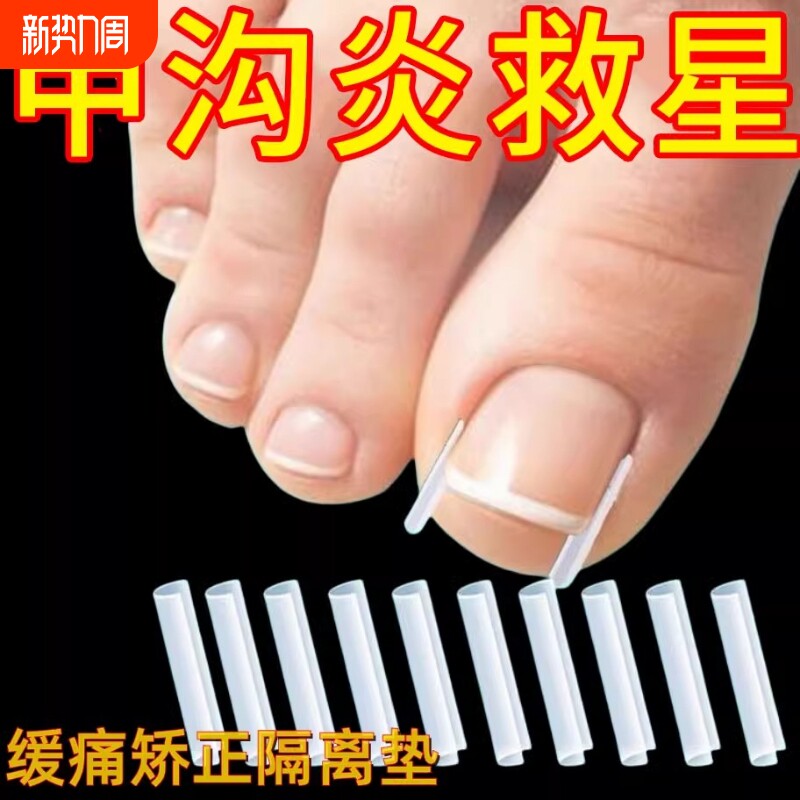 甲沟神器指甲矫正器嵌甲炎专用隔离填充垫片脚趾甲纠正甲修脚刀