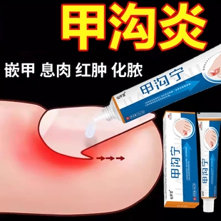 脚趾甲沟炎矫正器息肉软化剂药膏灰指甲脱甲膏凤仙花抑菌液脱甲液