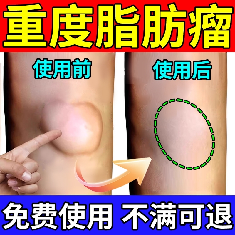 日系制药皮肤纤维瘤膏非消瘤膏乳腺贴囊肿脂肪瘤皮下粉瘤硬疙瘩