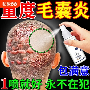 头皮毛囊炎喷雾剂头皮痒有疙瘩马拉色真菌头部硬专用皮肤消毒周围
