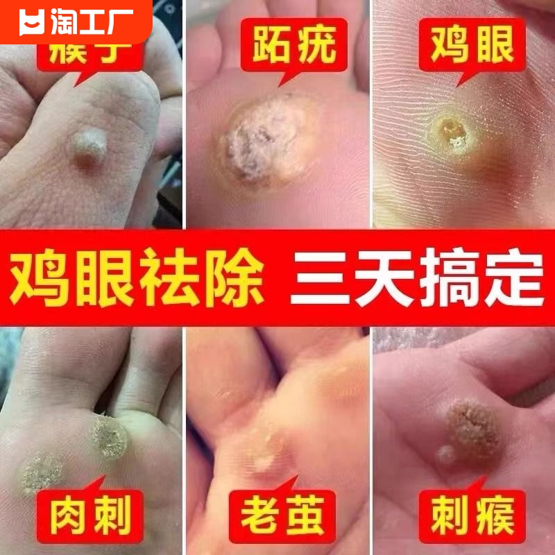 云南本草鸡眼贴鸡眼膏瘊子足部去脚底脚趾部跖疣灵老茧根肉刺