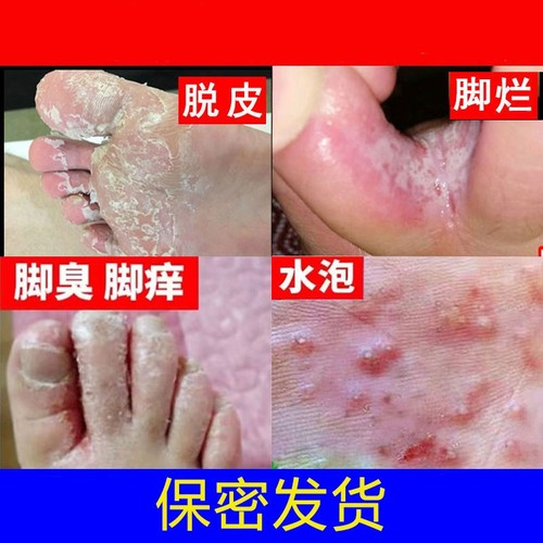脚痒杀菌脚痒水泡脱皮烂脚丫