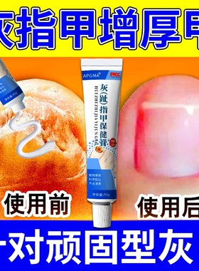 灰指甲专用脱甲膏治甲沟炎真菌感染息肉去除消肿嵌甲正品抑菌液