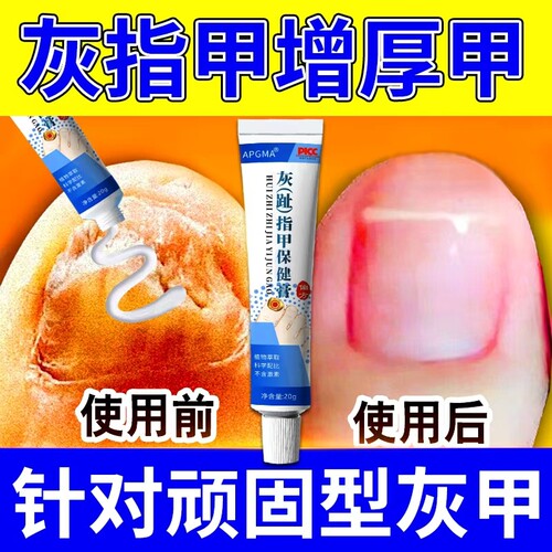 灰指甲专用脱甲膏治甲沟炎真菌感染息肉去除消肿嵌甲正品抑菌液