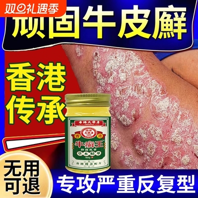 顽固牛皮癣银屑病专用膏手癣足癣股癣头皮癣湿疹止痒外用顽固皮炎