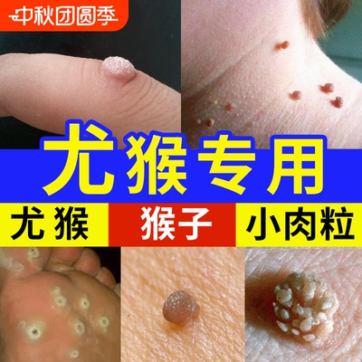 脖子上长小肉粒疙瘩尤瘊子一抹无忧猴子刺猴膏去除神器去疣修复