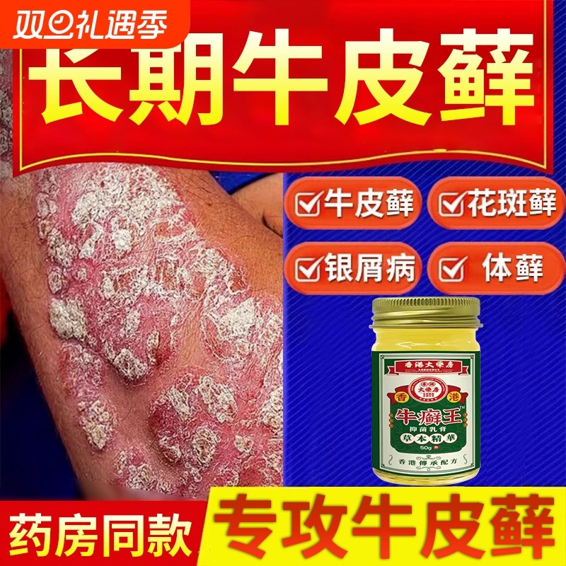 香港牛藓王牛皮痒癣头皮股银去屑病专用膏正品皮肤杀菌止抑菌痒