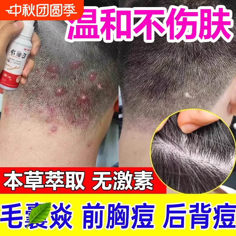 邹润安毛囊净抑菌喷剂专用部头皮上长痘痘特止痒抑菌效除螨净喷剂