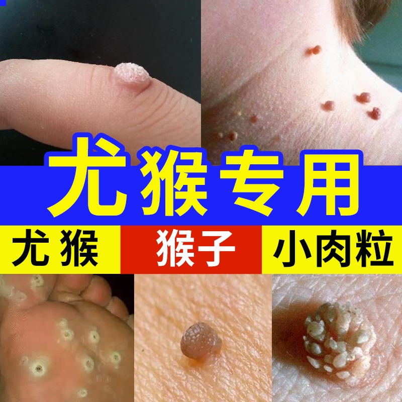 脖子上长小肉粒疙瘩尤瘊子一抹无忧猴子刺猴膏去除神器去疣修复