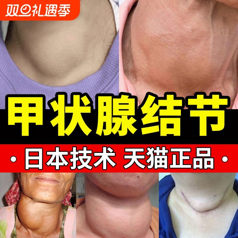 甲状腺结节消散结贴专用特效冷敷凝胶正品甲亢脖子淋巴结消肿大膏