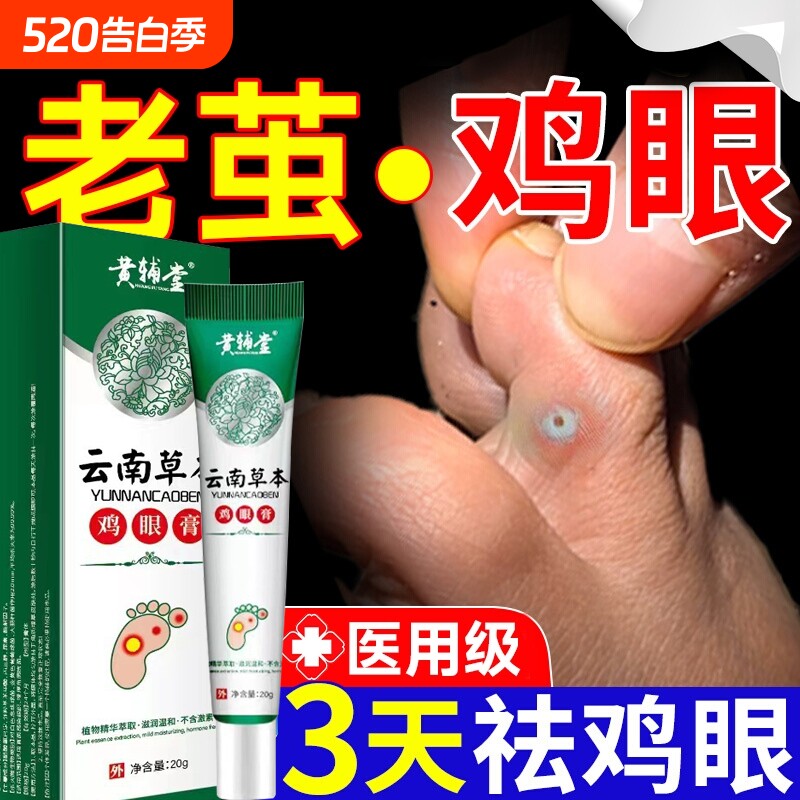云南草本鸡眼膏官方正品旗舰店鸡茧子鸡眼脚部脚底老茧20g医用级