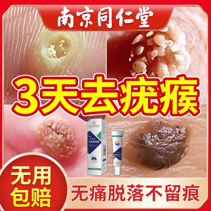 【销量No.I】扁平疣去疣瘊小肉粒