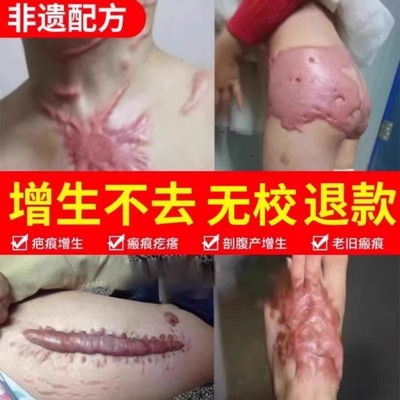 祛疤膏疤痕修复医用硅酮凝胶去疤痕除疤膏疤痕贴剖腹产增生护理药