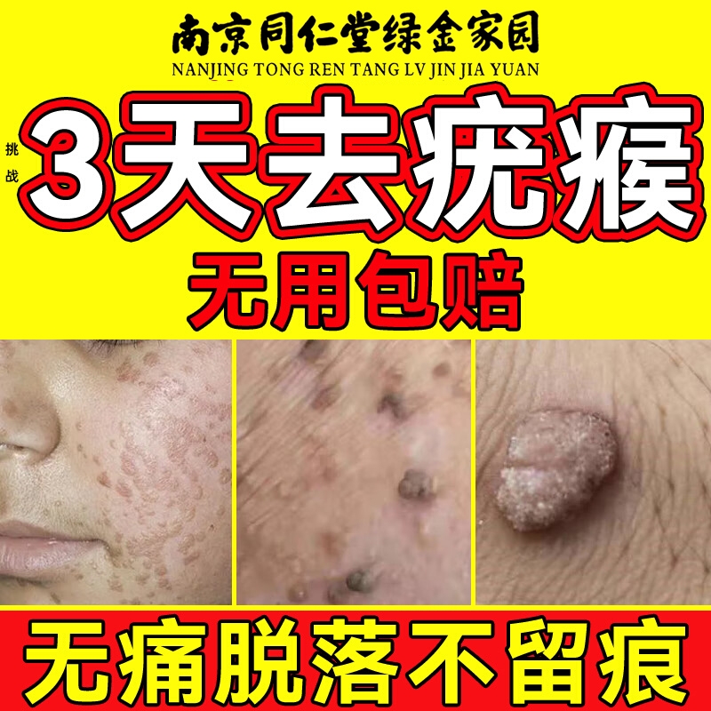 【胖东莱爆款】南京同仁堂疣清宁