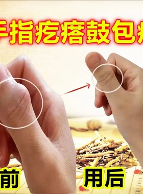 手指骨节粗大变形关节疙瘩鼓包肿大消肿疼痛专用活络