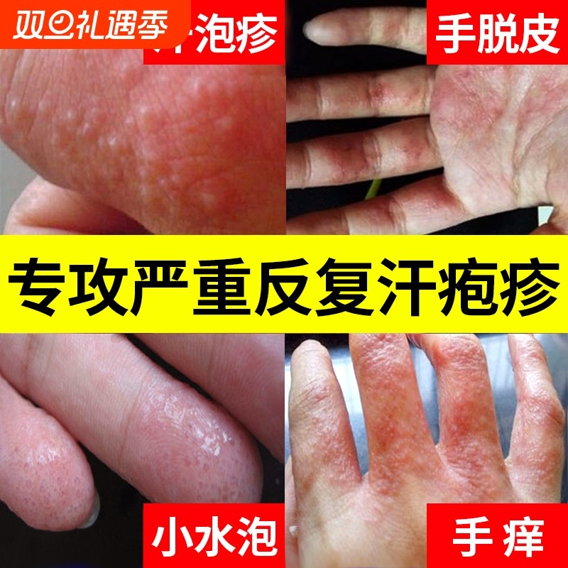 汗疱疹汗泡疱疹药膏汗孢疹去手上起小水泡手痒汗状湿疹止痒皮炎