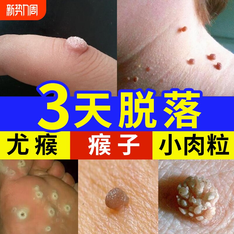 脖子上长小肉粒疙瘩尤刺猴瘊子去除神器一抹无忧丝状疣猴子膏去疣