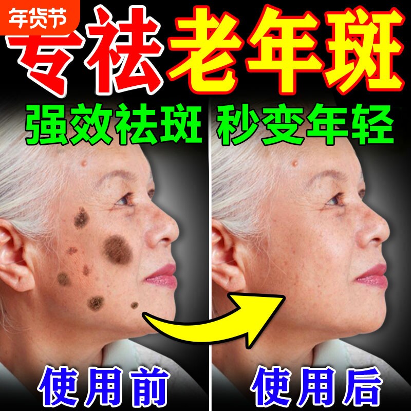老年斑美白祛斑霜黄褐专用膏药强力去手部除脸部一擦就掉中老年人
