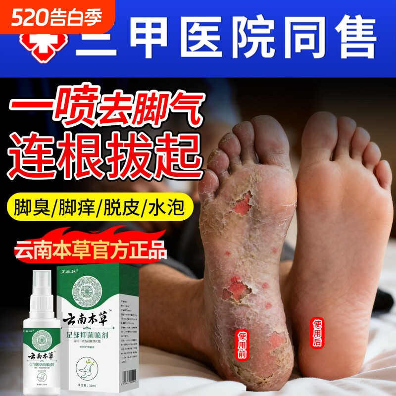 脚气喷雾止脱皮痒杀菌去真菌感染专用特根糜烂脚丫脚趾缝除臭出汗