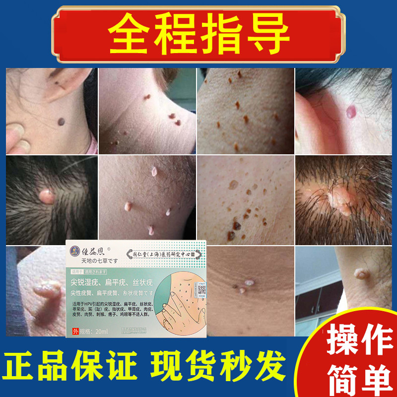 血胞刺去除膏根脚肉刺猴跖疣净祛修子非药鱼鳞痣点腋下肉粒痦候治