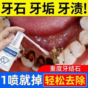 美白去黄去口臭烟渍牙结石专用速清理洗白去渍效异味清新口气喷剂