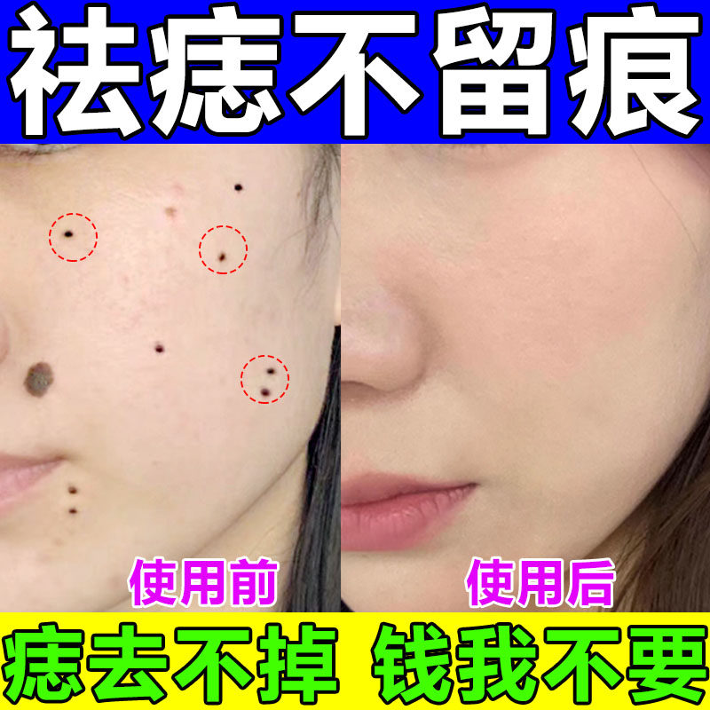 去痣点痣的药膏无痕正品祛斑纯中药反黑修复脸上疤痕液去肉疣神器