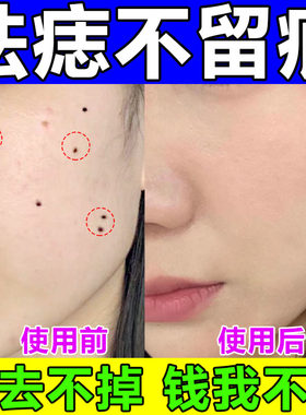 去痣点痣的药膏无痕正品祛斑纯中药反黑修复脸上疤痕液去肉疣神器