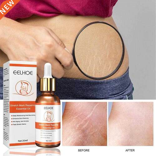 20ml Stretch Marks Removal Oil Pregnant Women Pregnancy Mate