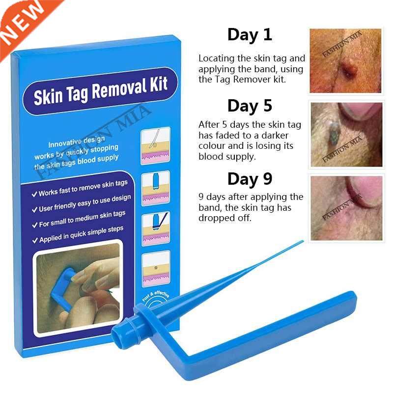 Blue Set Skin Tag Removal Kit Home Use Mole Wart Remover Equ